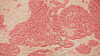 kan psoriasis smitte kan psoriasis smitte
